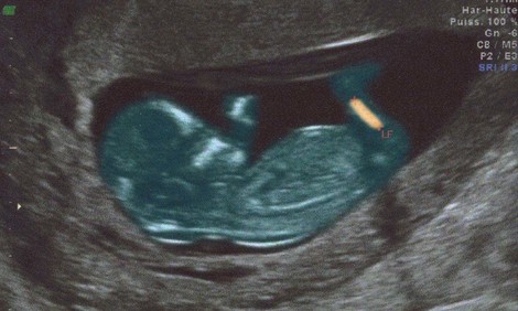 Transplantierbare Gebärmutter - wo finden zukünftig Schwangerschaften statt ? Und der Feminismus?