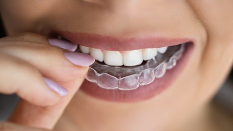 Zähneknirschen: Brauchst du wirklich eine Schiene?